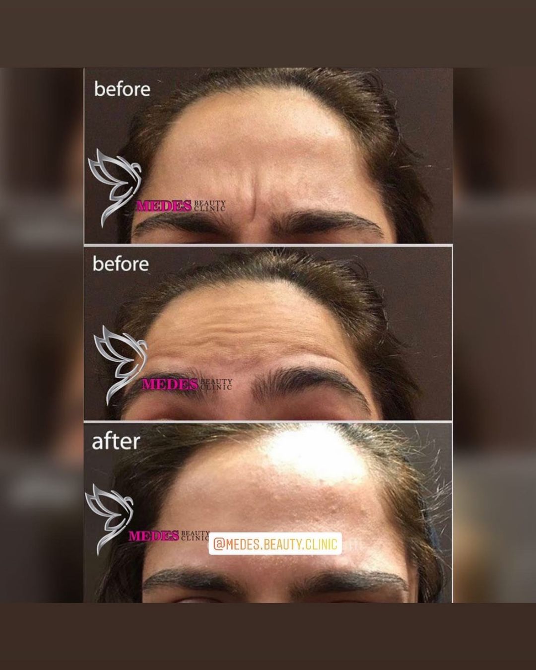 گالری تزریق بوتاکس